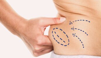 Squeezing excess fat from the side of the abdomen to demonstrate body contouring and weight loss goals.