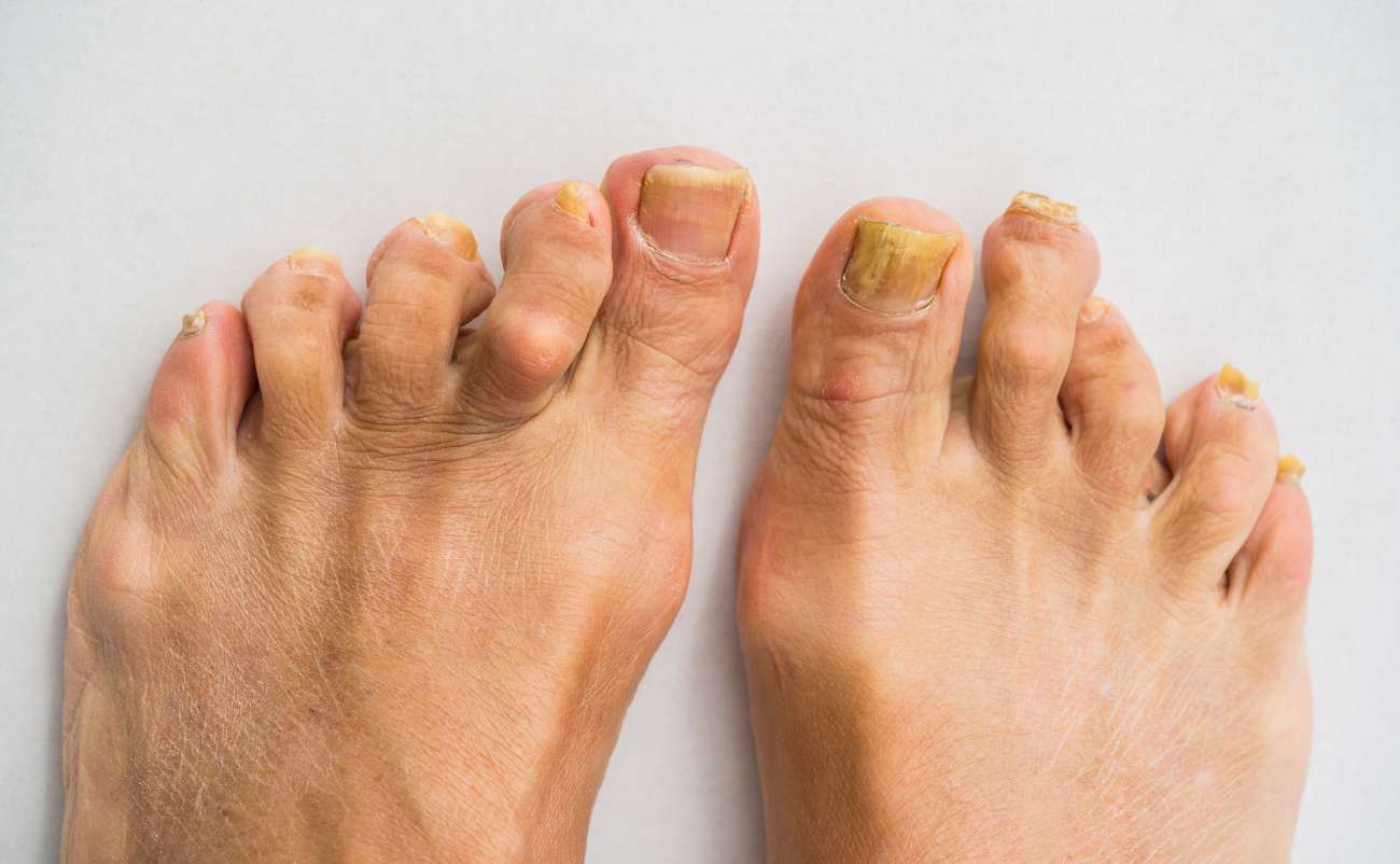 Cracked, discolored toenails on both feet showing signs of fungal infection or nail health issues.